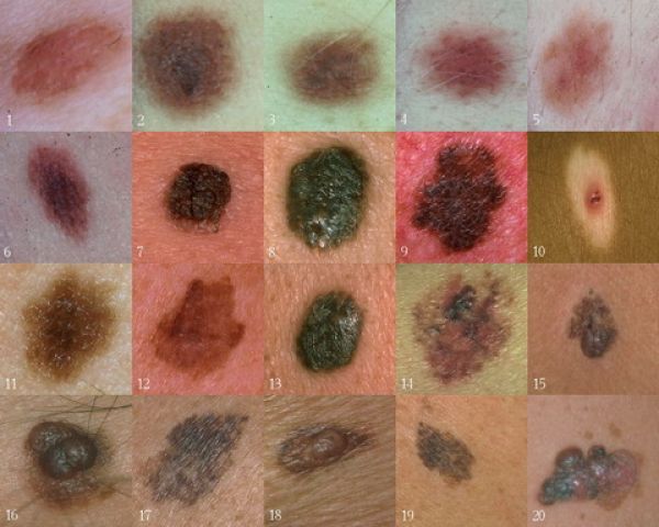 Bőrrák – Rosszindulatú bőrdaganatok