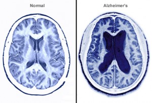 MRI-Alzheimer