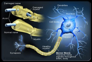 multiple-sclerosis